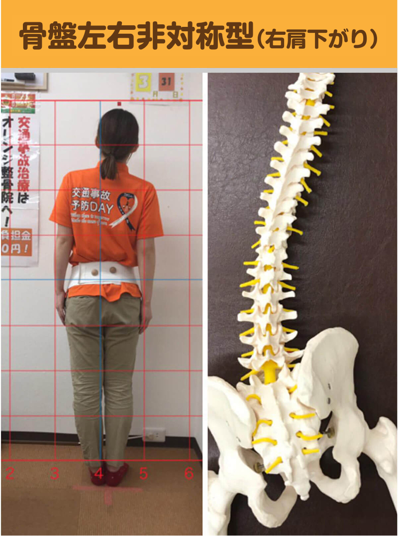 骨盤左右非対称型（右肩下がり）